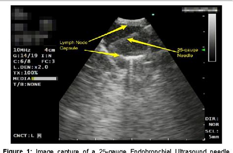 Figure From The Role Of Endobronchial Ultrasound Guided