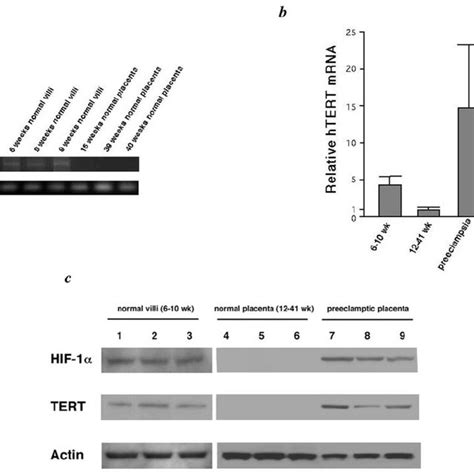 A Representative Htert Mrna Expression In Placenta Normal Villi And Download Scientific