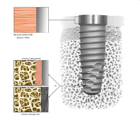 Tissue Integration Of A Dental Implant Note The Intimate Contact With Download Scientific