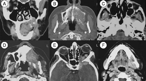 Carcinoma Epidermoide Del Seno Maxilar Binipatia E Higienismo