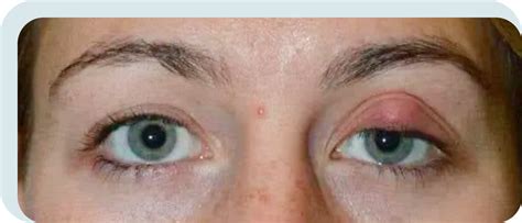 Eye Cyst Chalazion Removal London Transparent Cost