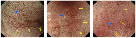 Frontiers Detection And Characterization Of Early Gastric Cancer