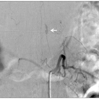 Spinal Angiography Of The Segmental Artery At The Left L1 Level Shows