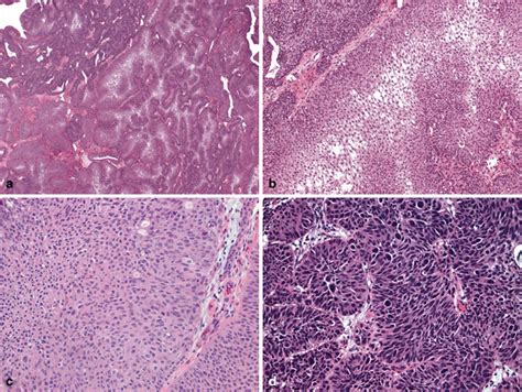 Classification Of Adult Renal Tumors And Grading Of Renal Cell Carcinoma Basicmedical Key