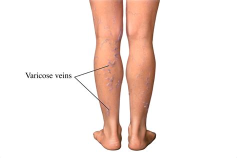 Varicose Veins Varicose Veins Nhlbi Nih