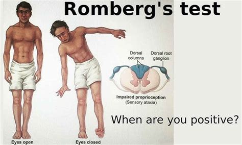 Romberg test or Romberg sign. How to perform & interpret a Romberg sign