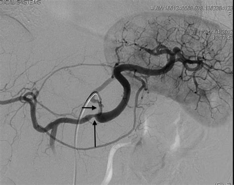 Celiac trunk angiography shows stenosis and a small pseudoaneurysm of ...