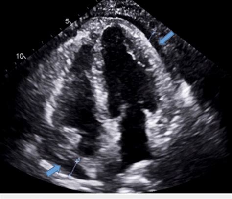 Apical 4 Chamber View Showing A Moderate Pericardial Effusion