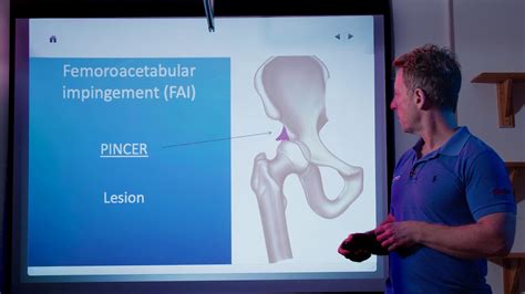 Hip Joint Pathologies Causing Back Groin Buttock Knee Pain YouTube