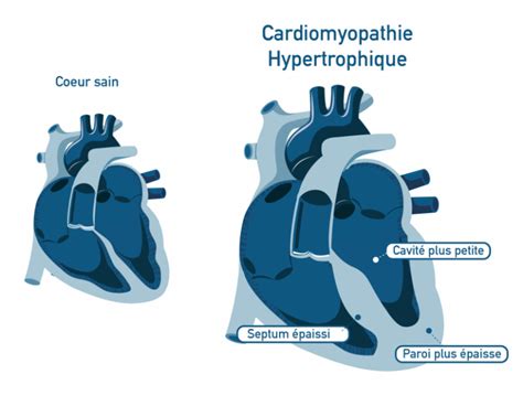 Cardiomyopathie hypertrophique dilatée non compaction du ventricule