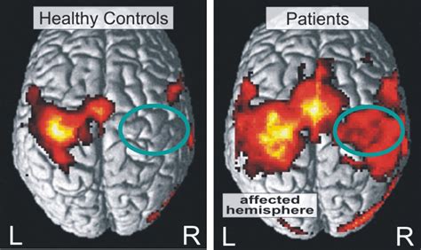 Mini stroke symptoms | General center | SteadyHealth.com