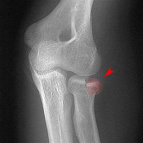 Radial Head Fracture Treatment Dr Arthur Turow