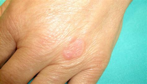 Kas Yra Granuloma