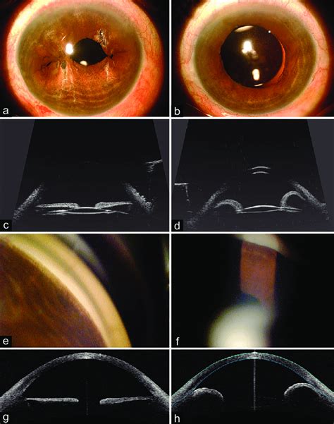 Iridodialysis Gonioscopy