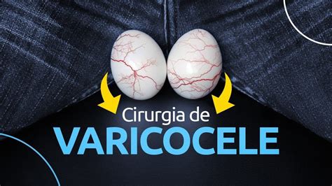 Como é Feita A Cirurgia De Varicocele Youtube