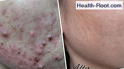 Dalacin C hard capsules and solution for injection 🏥 Disease, Symptoms ...