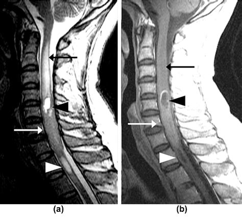 Differentiation Between Intramedullary Spinal Ependymoma And