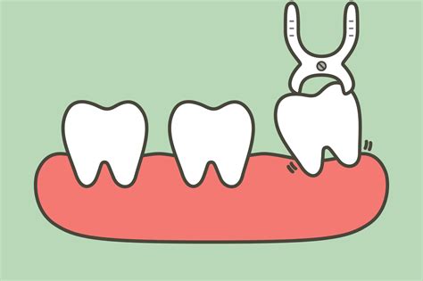 Extraction Des Dents De Sagesse Clinique Poirier Centre Dentaire