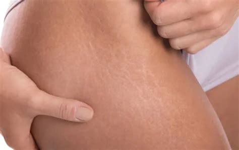 Dermatologists Office In Bakersfield Treatment For Stretch Marks