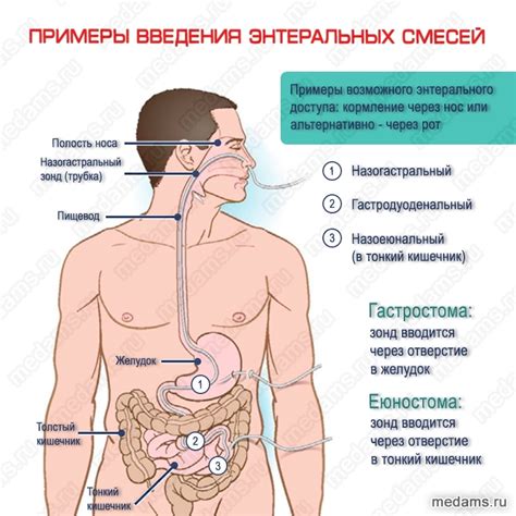 Система (набор) для введения энтерального питания с мешком и без мешка ...
