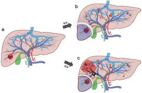 Early Explosive Recurrence Of Hepatocellular Carcinoma After Radical Resection Risk Factors And