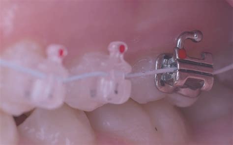 Qu Son Los Tubos De Ortodoncia Cl Nica Dental Ebrecl Nic