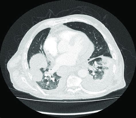 Chest CT scan demonstrating pleural thickening of the inferior half of ...