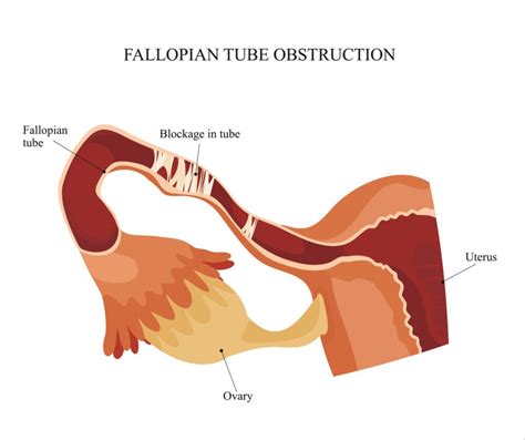 What Is Pelvic Inflammatory Disease Pid