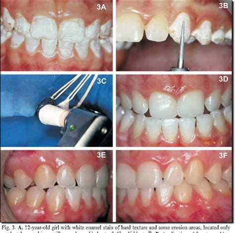 Figure From Microabrasion In Tooth Enamel Discoloration 57 OFF