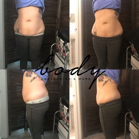 Body Contouring Services Ultrasonic Lipo Vacuum Dr Tara Rasta