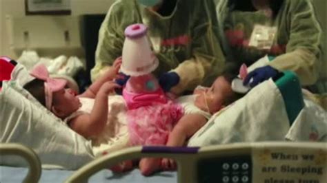 Surgery Separates Infant Conjoined Twins In Texas Abc11 Raleigh Durham