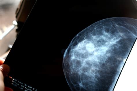 More Mammograms May Not Reduce Breast Cancer Deaths Study Finds Kqed