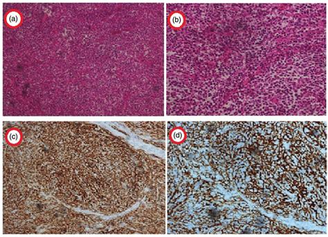 Histological Features And Immunohistochemical Results Of Colonic