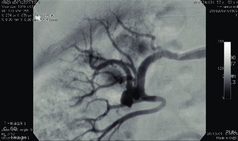 Arteriografia Renal Direita Aneurisma De Art Ria Renal Complexo