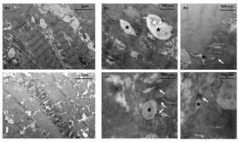 Electron Microscopy Of Heart Samples From Arvd C The Electronic