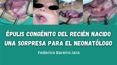 Épulis CongÉnito Del Recién Nacido Una Sorpresa Para El Neonatólogo