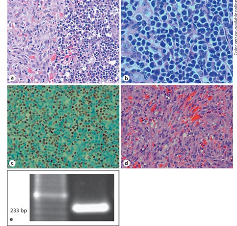 Figure From Kaposi Sarcoma Associated Herpesvirus Human Herpesvirus