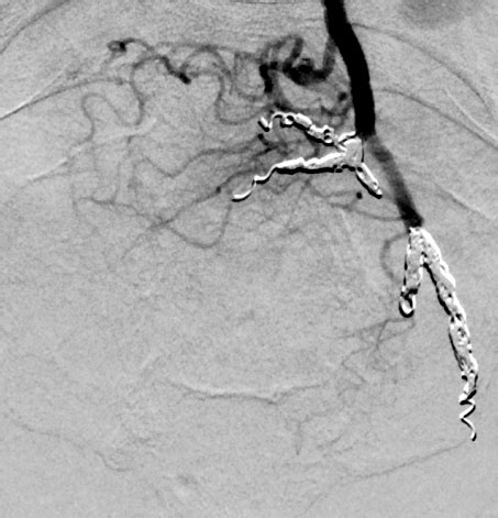 Visceral Embolization Case Albany Ir