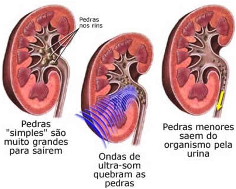 ANATOMIA É VIDA Cálculo Renal ou Pedra nos rins