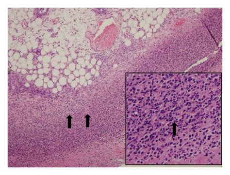 The Effects Of Dbt On Eosinophil Infiltration In Skin Skin Sections Download Scientific