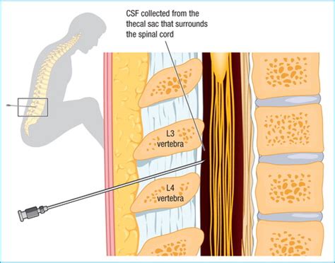 Lumbar Puncture Landmarks
