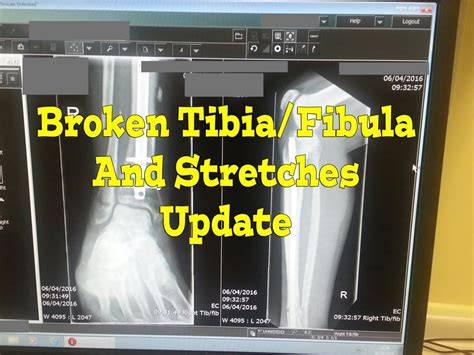 Broken Tibia Fibula Progress Update Xray And Stretches Artofit