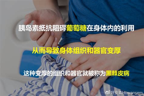 什么是黑棘皮病？与糖尿病有何关系？财经头条