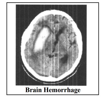 Brain Hemorrhage