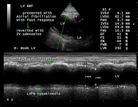 Tropical Coronary Artery Disease And Arrhythmogenic Potentialsthe