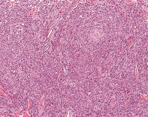 Pathology Outlines Peripheral T Cell Lymphoma Nos