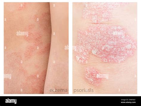 Close Up Difference Between Psoriasis And Eczema Atopic Dermatitis