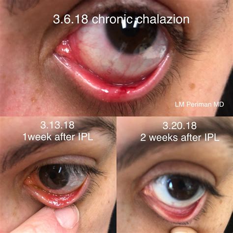 Chalazion Removal