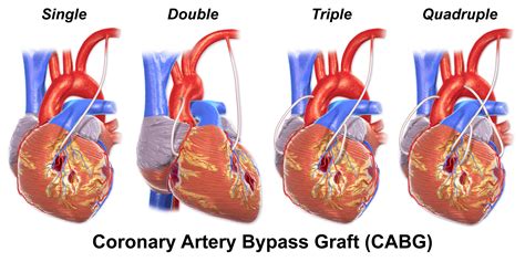 Coronary Artery Bypass Grafting CABG Almostadoctor