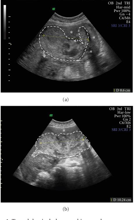 Figure 1 From Conservative Management Of Placenta Accreta In A